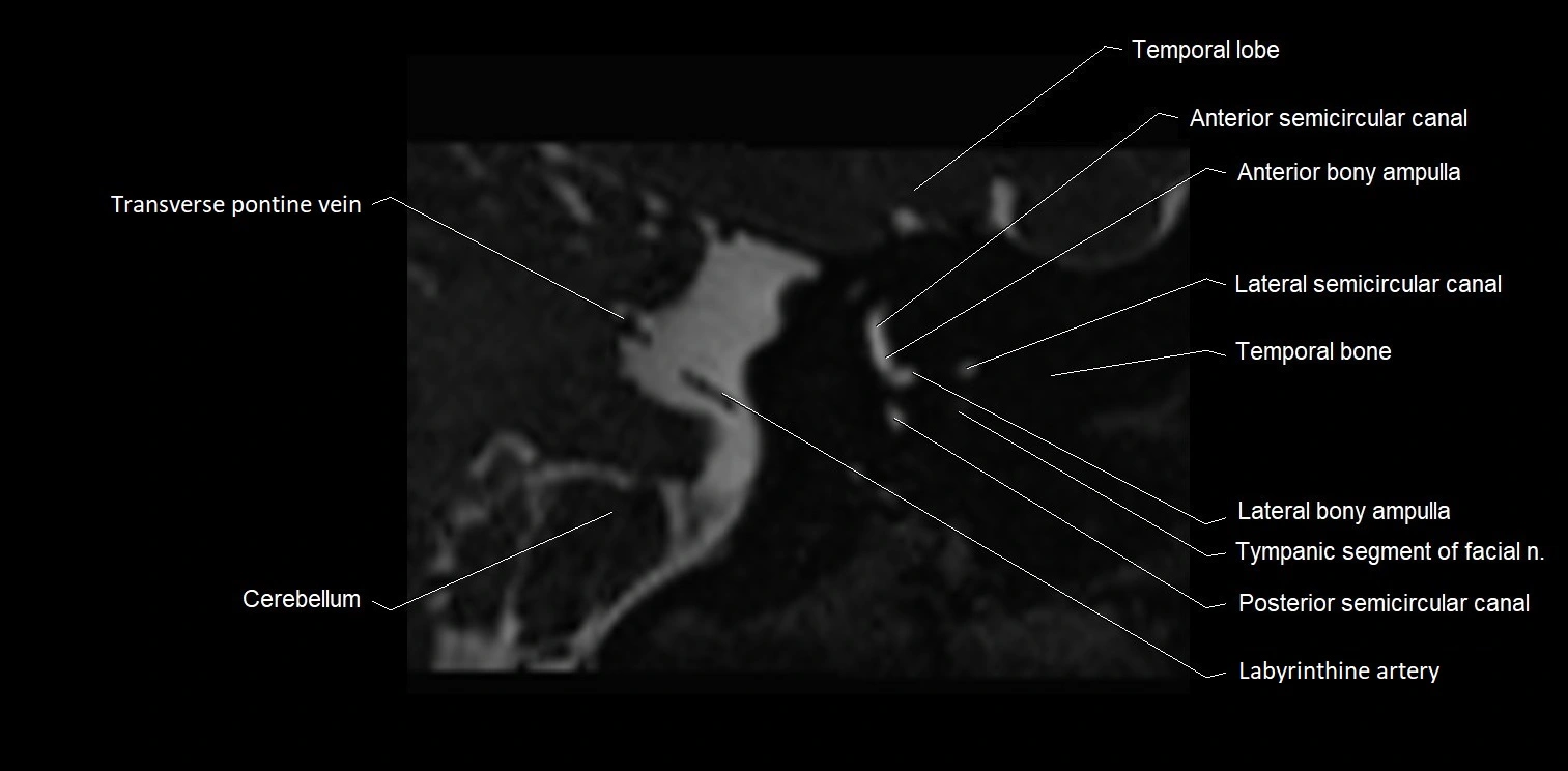 MRI Internal auditory meatus (IAM) coronal cross sectional labelled anatomy image 25.webp